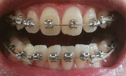 陶瓷牙套 优缺点（陶瓷牙套是什么）(图1)